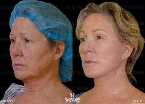 wave plastic surgery